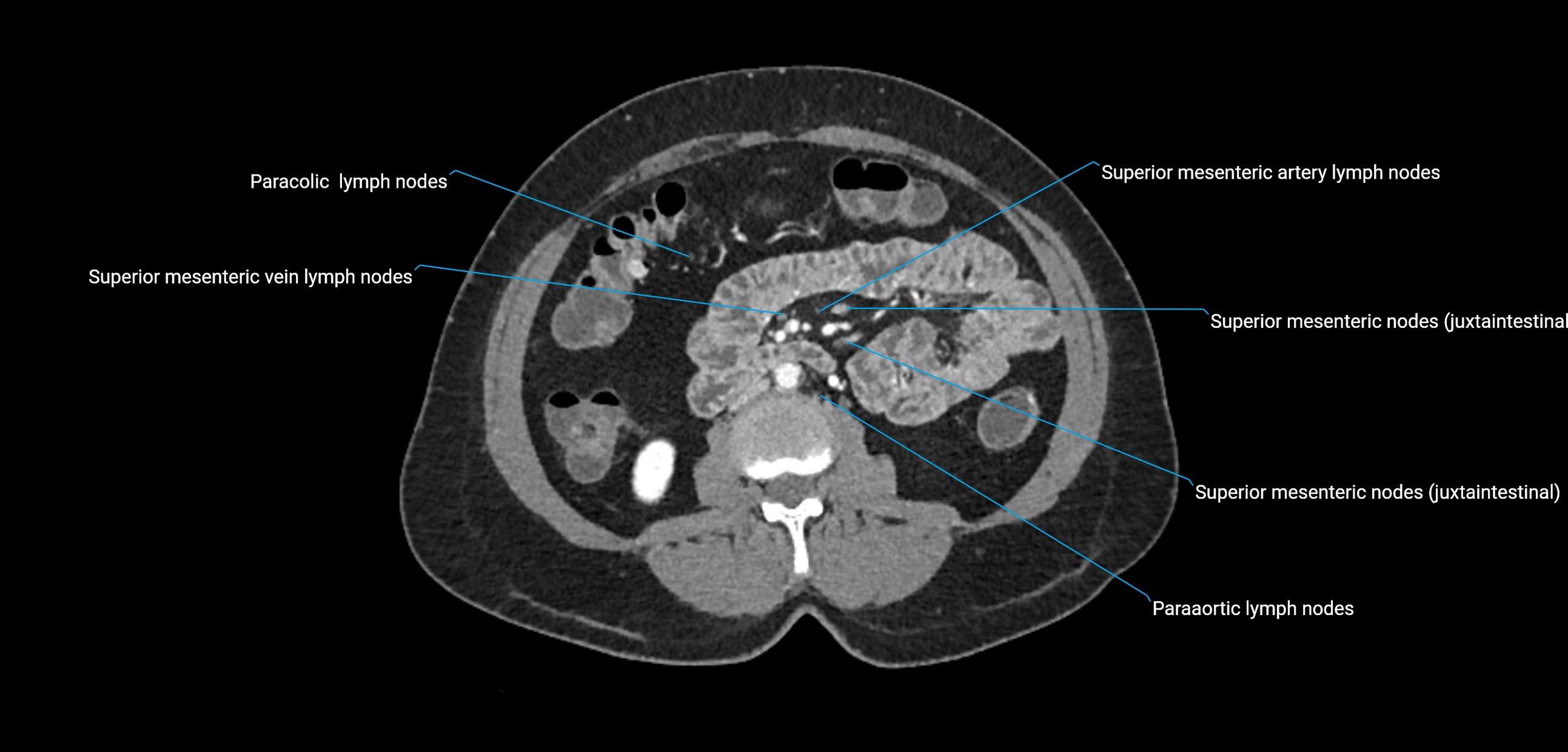 CT ct abdominal lymph nodes  axial cross sectional anatomy  enchanced radiology image -img-00002-00217.webp